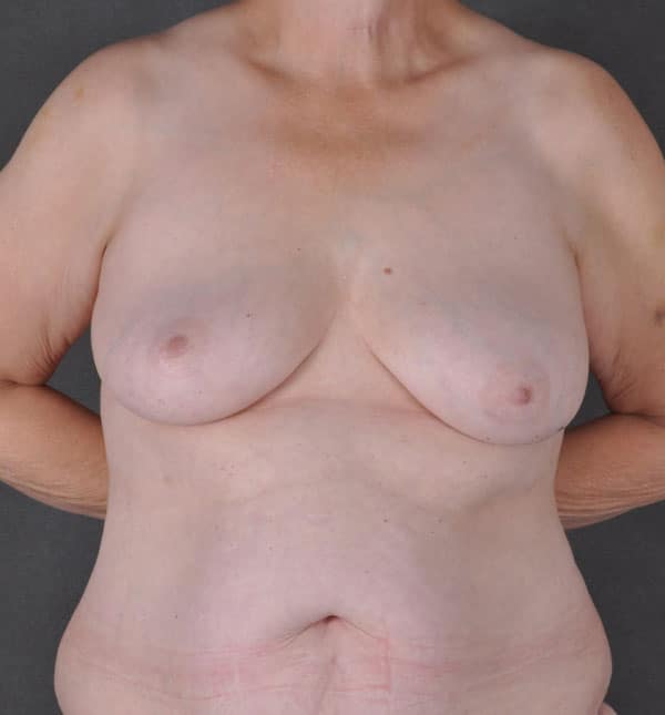 breast lift - patient 9298 - before 1 breast lift - patient 9298 - before 1