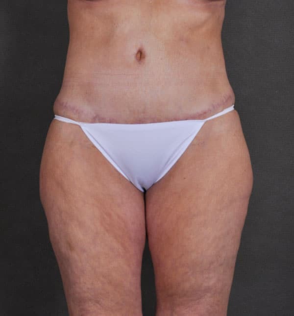 breast lift - patient 9298 - after 4 breast lift - patient 9298 - after 4