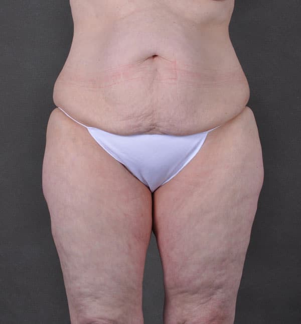 breast lift - patient 9298 - before 4 breast lift - patient 9298 - before 4