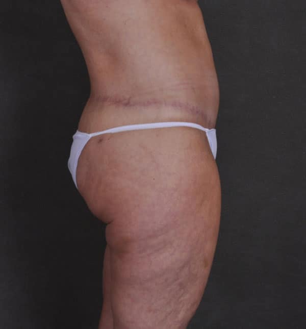 breast lift - patient 9298 - after 6 breast lift - patient 9298 - after 6