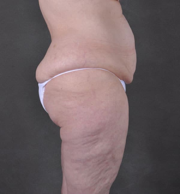 breast lift - patient 9298 - before 6 breast lift - patient 9298 - before 6