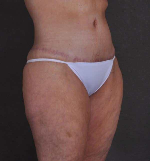 breast lift - patient 9298 - after 5 breast lift - patient 9298 - after 5