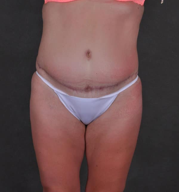 tummy tuck - patient 9275 - after 1 tummy tuck - patient 9275 - after 1