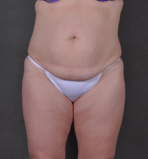 tummy tuck - patient 9275 - before 1 tummy tuck - patient 9275 - before 1
