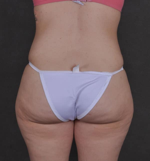 tummy tuck - patient 9308 - after 4 tummy tuck - patient 9308 - after 4