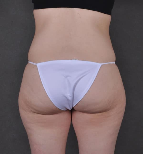 tummy tuck - patient 9308 - before 4 tummy tuck - patient 9308 - before 4