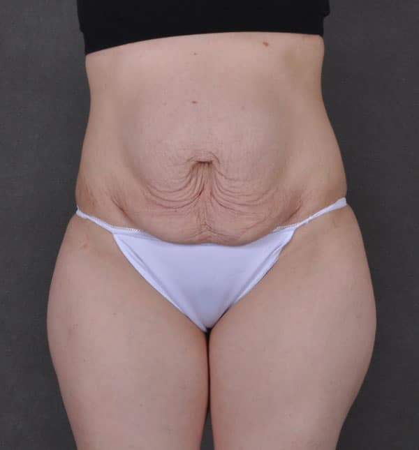 tummy tuck - patient 9308 - before 1 tummy tuck - patient 9308 - before 1