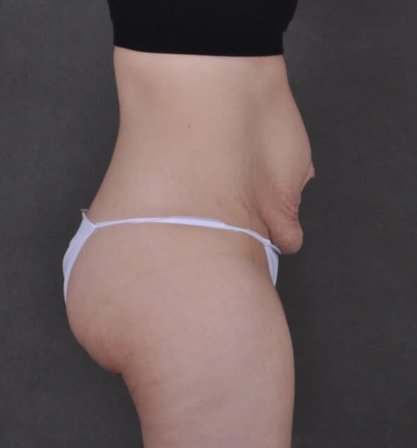 tummy tuck - patient 9308 - before 3 tummy tuck - patient 9308 - before 3