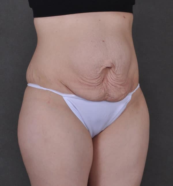 tummy tuck - patient 9308 - before 2 tummy tuck - patient 9308 - before 2