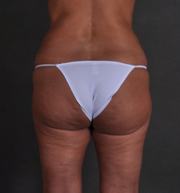 brazilian butt lift - patient 9339 - after 4 brazilian butt lift - patient 9339 - after 4
