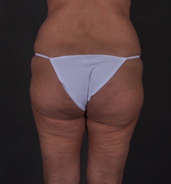 brazilian butt lift - patient 9339 - before 4 brazilian butt lift - patient 9339 - before 4