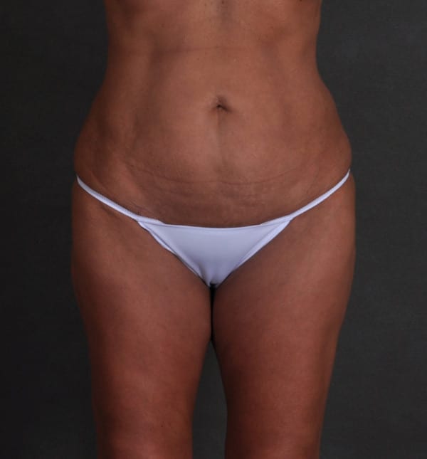 brazilian butt lift - patient 9339 - after 1 brazilian butt lift - patient 9339 - after 1