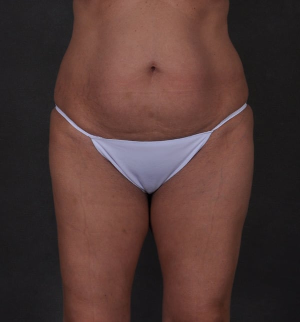 brazilian butt lift - patient 9339 - before 1 brazilian butt lift - patient 9339 - before 1