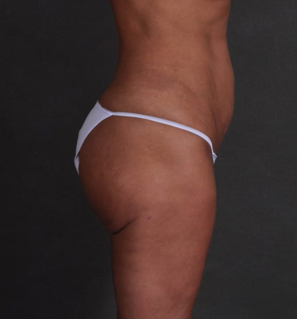brazilian butt lift - patient 9339 - after 3 brazilian butt lift - patient 9339 - after 3