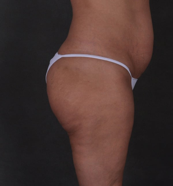 brazilian butt lift - patient 9339 - before 3 brazilian butt lift - patient 9339 - before 3