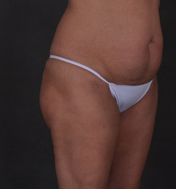 brazilian butt lift - patient 9339 - before 2 brazilian butt lift - patient 9339 - before 2