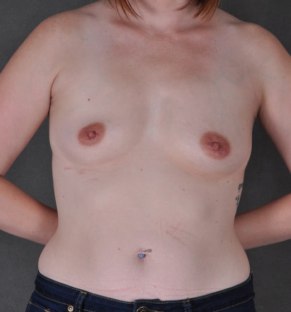 breast augmentation - patient 9370 - before 1 breast augmentation - patient 9370 - before 1