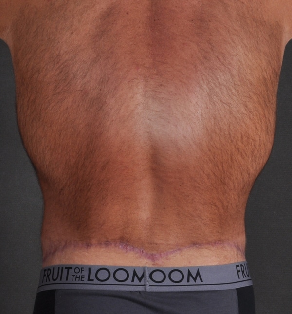 tummy tuck - patient 9436 - after 4 tummy tuck - patient 9436 - after 4