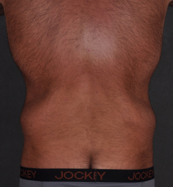 tummy tuck - patient 9436 - before 4 tummy tuck - patient 9436 - before 4