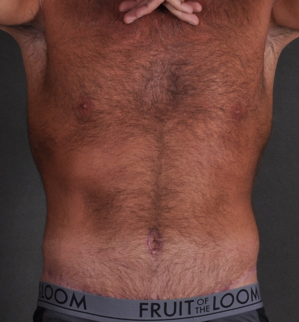 tummy tuck - patient 9436 - after 1 tummy tuck - patient 9436 - after 1