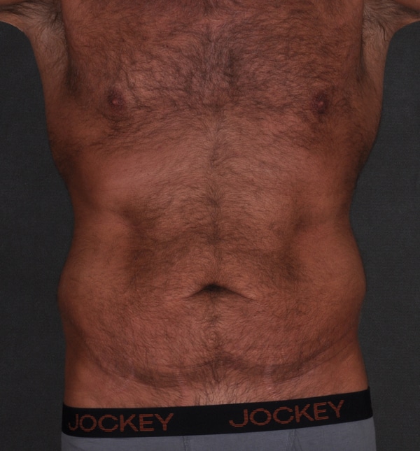 tummy tuck - patient 9436 - before 1 tummy tuck - patient 9436 - before 1