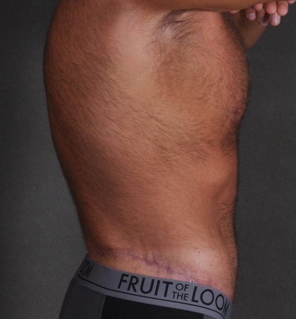 tummy tuck - patient 9436 - after 3 tummy tuck - patient 9436 - after 3