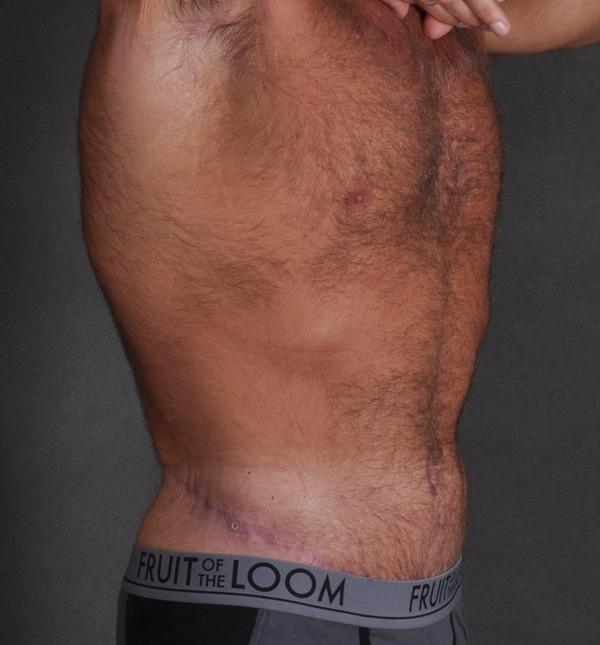 tummy tuck - patient 9436 - after 2 tummy tuck - patient 9436 - after 2