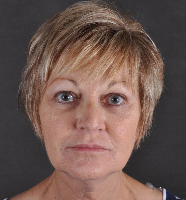 blepharoplasty - patient 9457 - after 1 blepharoplasty - patient 9457 - after 1