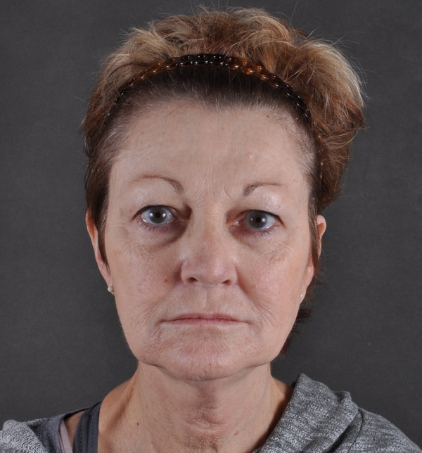 blepharoplasty - patient 9457 - before 1 blepharoplasty - patient 9457 - before 1