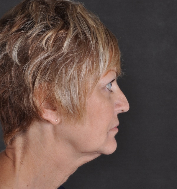 blepharoplasty - patient 9457 - after 2 blepharoplasty - patient 9457 - after 2