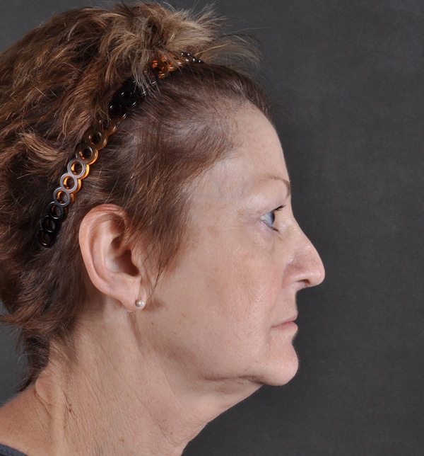 blepharoplasty - patient 9457 - before 2 blepharoplasty - patient 9457 - before 2