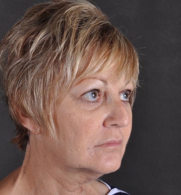 blepharoplasty - patient 9457 - after 3 blepharoplasty - patient 9457 - after 3