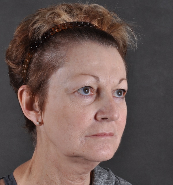 blepharoplasty - patient 9457 - before 3 blepharoplasty - patient 9457 - before 3