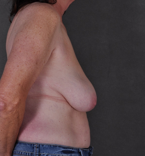 breast lift - patient 9505 - before 3 breast lift - patient 9505 - before 3