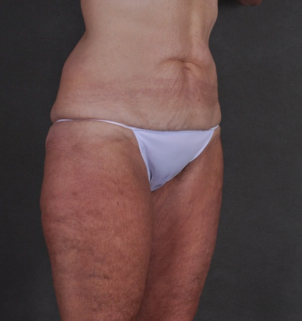 mommy makeover - patient 9512 - before 5 mommy makeover - patient 9512 - before 5