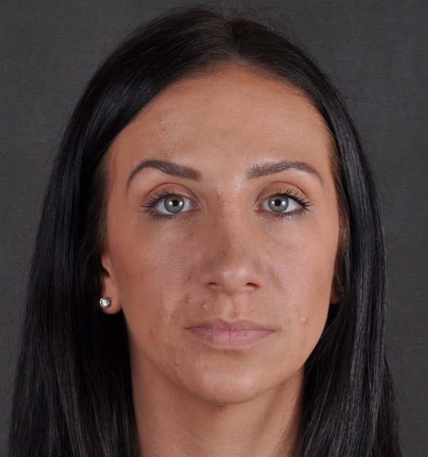 rhinoplasty - patient 9488 - after 1 rhinoplasty - patient 9488 - after 1