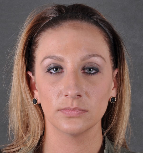 rhinoplasty - patient 9488 - before 1 rhinoplasty - patient 9488 - before 1