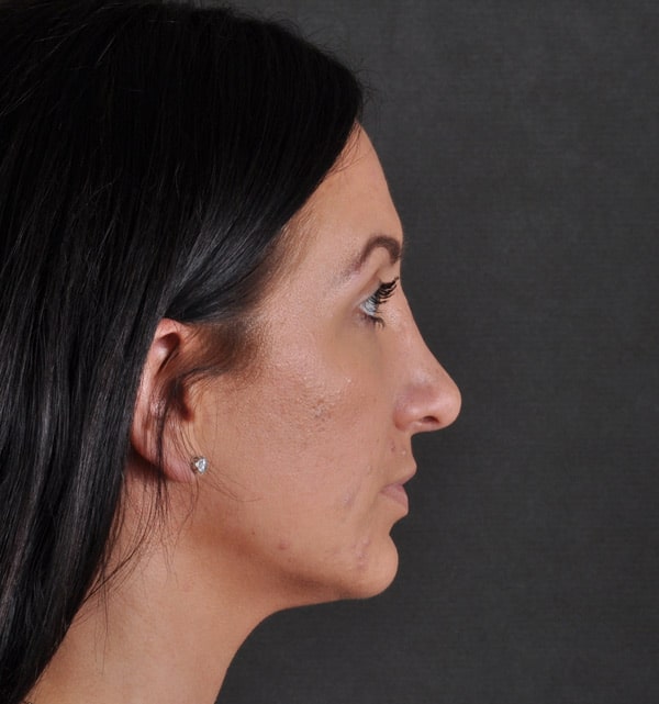rhinoplasty - patient 9488 - after 3 rhinoplasty - patient 9488 - after 3