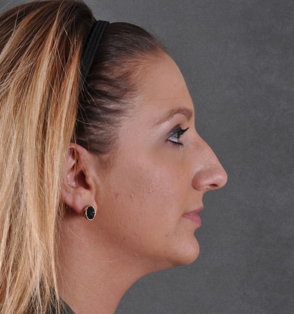 rhinoplasty - patient 9488 - before 3 rhinoplasty - patient 9488 - before 3