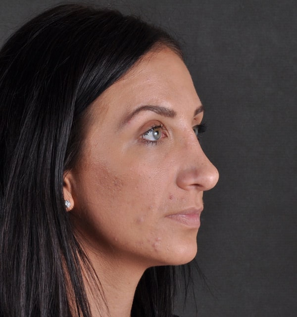 rhinoplasty - patient 9488 - after 2 rhinoplasty - patient 9488 - after 2