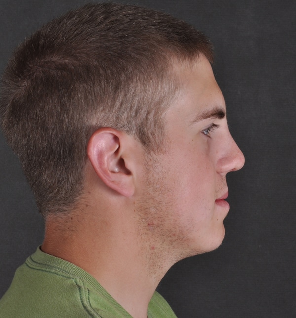 rhinoplasty - patient 9538 - after 3 rhinoplasty - patient 9538 - after 3