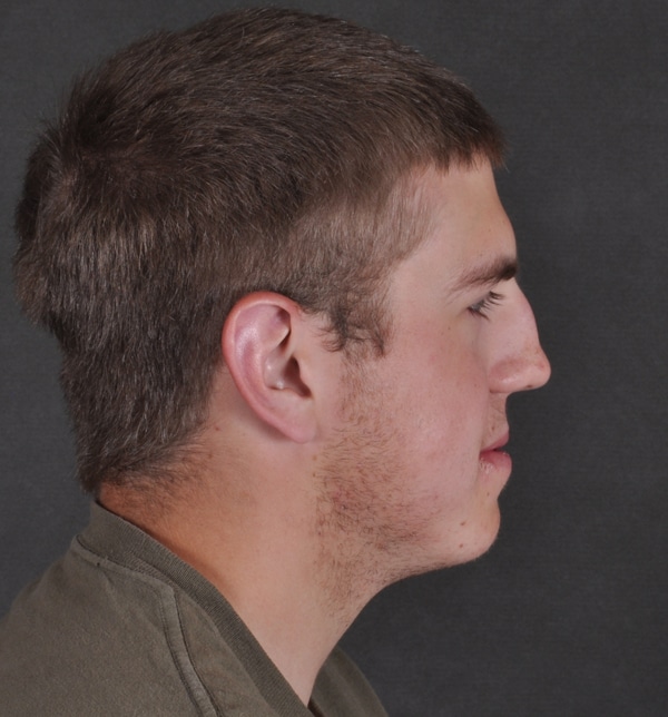 rhinoplasty - patient 9538 - before 3 rhinoplasty - patient 9538 - before 3