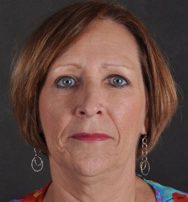 blepharoplasty - patient 9712 - after 1 blepharoplasty - patient 9712 - after 1