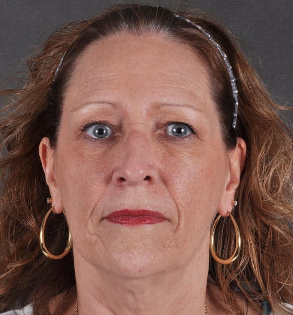 blepharoplasty - patient 9712 - before 1 blepharoplasty - patient 9712 - before 1