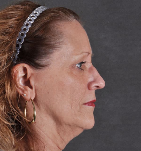 blepharoplasty - patient 9712 - before 3 blepharoplasty - patient 9712 - before 3
