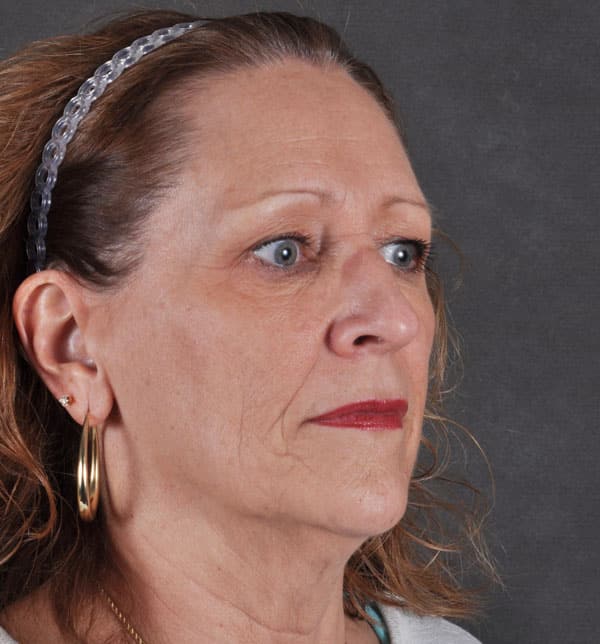 blepharoplasty - patient 9712 - before 2 blepharoplasty - patient 9712 - before 2