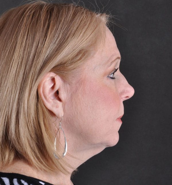 blepharoplasty - patient 9793 - after 3 blepharoplasty - patient 9793 - after 3