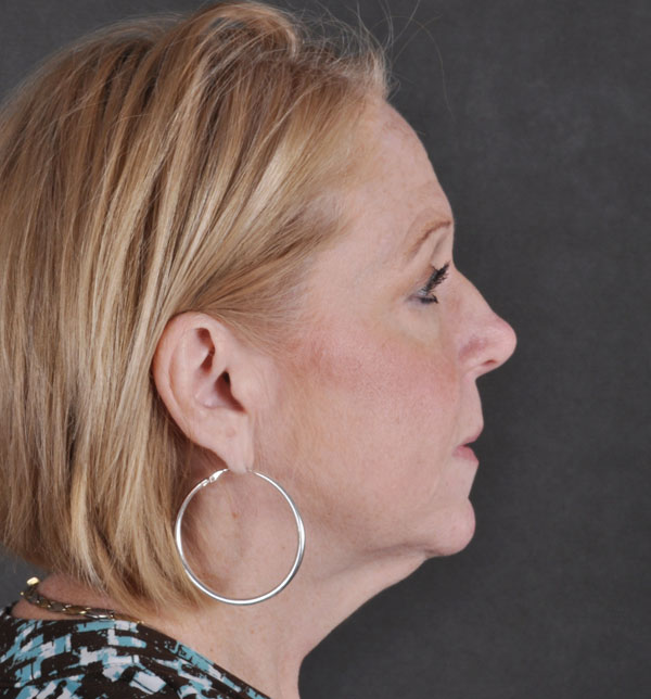 blepharoplasty - patient 9793 - before 3 blepharoplasty - patient 9793 - before 3