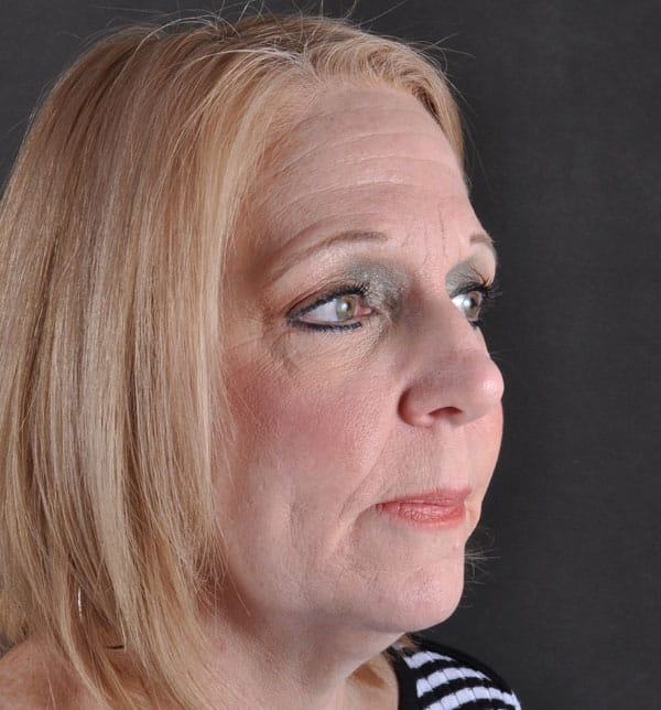 blepharoplasty - patient 9793 - after 2 blepharoplasty - patient 9793 - after 2