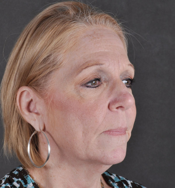 blepharoplasty - patient 9793 - before 2 blepharoplasty - patient 9793 - before 2